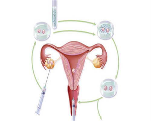 代生小男孩-卵巢囊肿必须切除输卵管吗