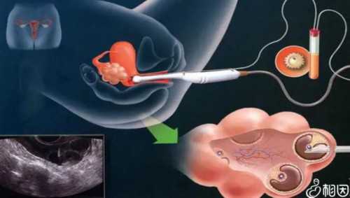 女性子宫内膜薄需要治疗多久可以怀孕？多方面结让内膜长更快