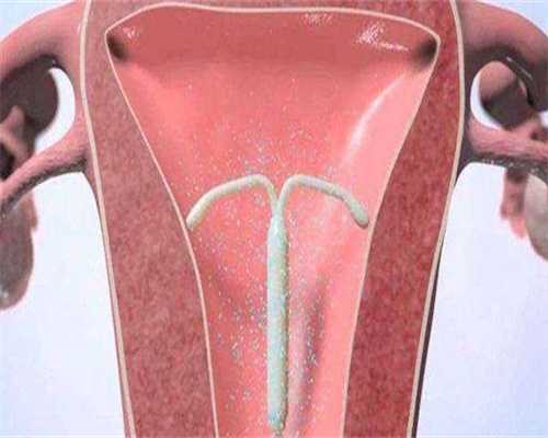 自身骨髓干细胞修复子宫内膜