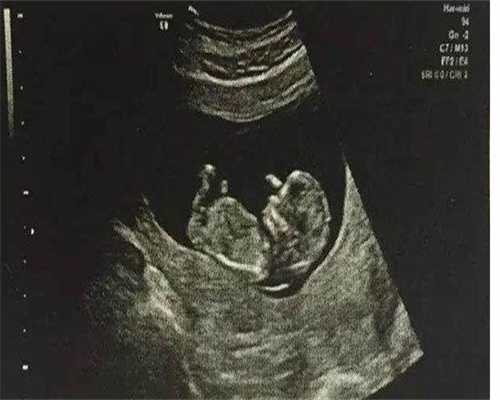 代生男孩中介-巨细胞病毒抗体igm阳性高一点可不可以试管 巨细胞病毒阳性影响试管移植