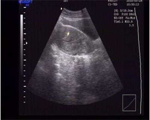 代生要多少钱-备孕女性吃鹿胎膏易受孕吗