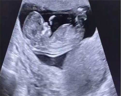 顺产好还是剖腹产好？试管婴儿是不是一定要剖腹产？