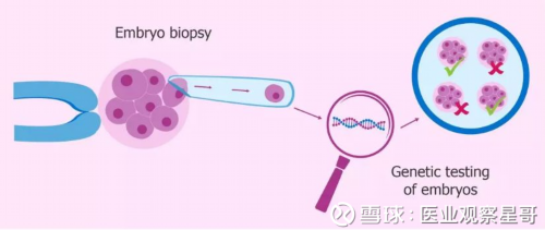 试管婴儿拮抗剂方案促排的具体过程 拮抗剂方案能*吗