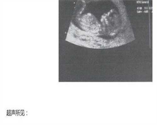 孕晚期缺铁性贫血可以喝红糖水吗