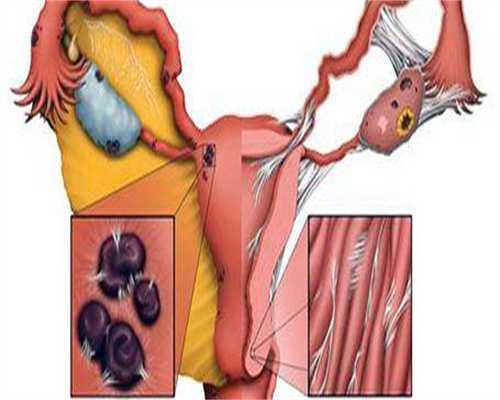 多囊卵巢治疗要查什么