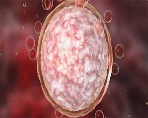 多囊卵巢能彻底治好吗