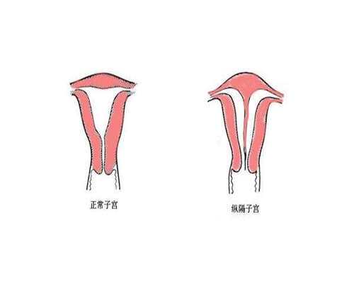 多囊清宫后会自然怀孕吗