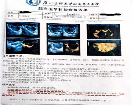 看胎心胎芽是腹部B超还是阴超