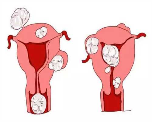 多囊卵巢白带什么症状多囊卵巢白带会有血吗