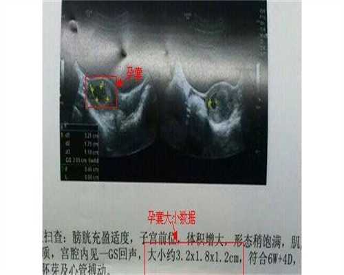 详解宫腔粘连的起因和危害